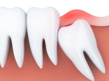 Tooth Extraction and Embedded Tooth Extraction