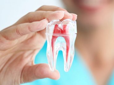 Root Canal Treatments